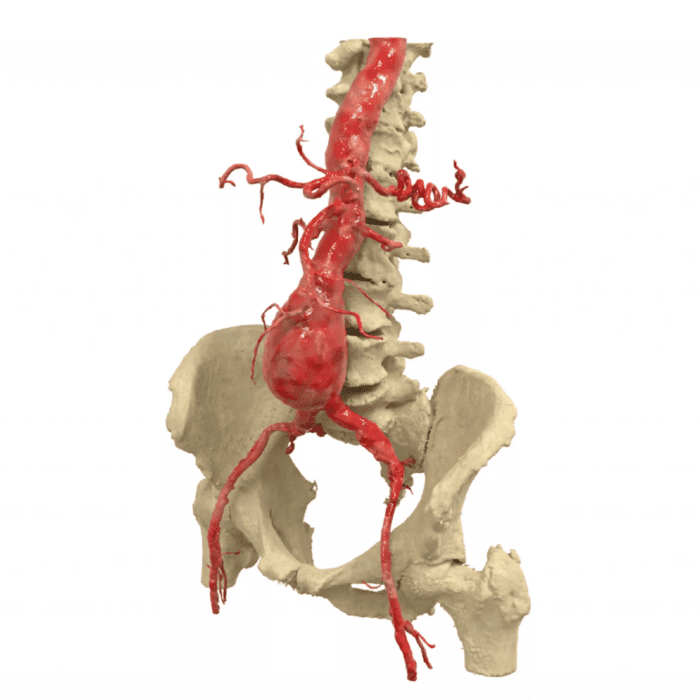 Ivace+i Innovación financia una herramienta asistida por inteligencia artificial para anticipar el riesgo de rotura de aneurismas de aorta abdominal